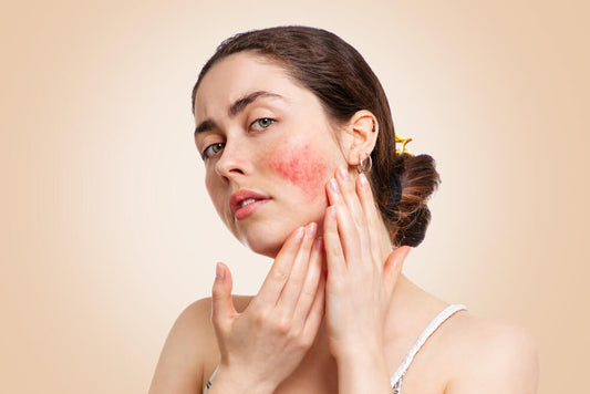 skin redness rosacea