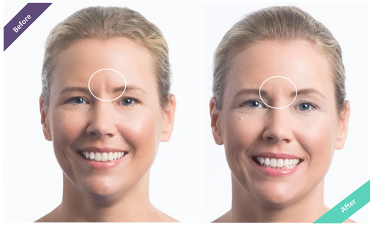 dermal fillers