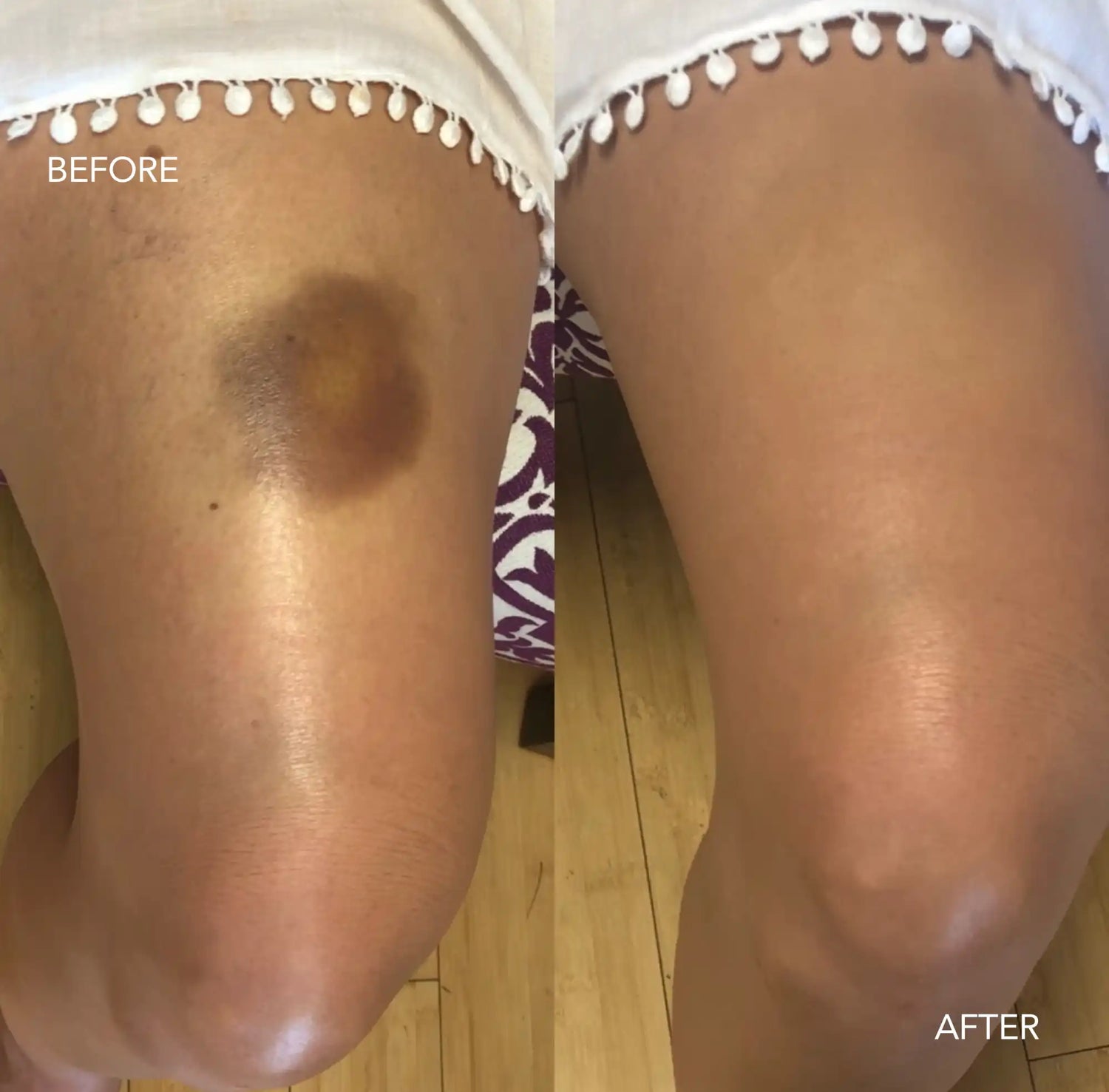 best bruise cover up