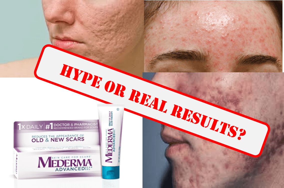 focus-on-different-types-of-acne-scars-medlaserusa