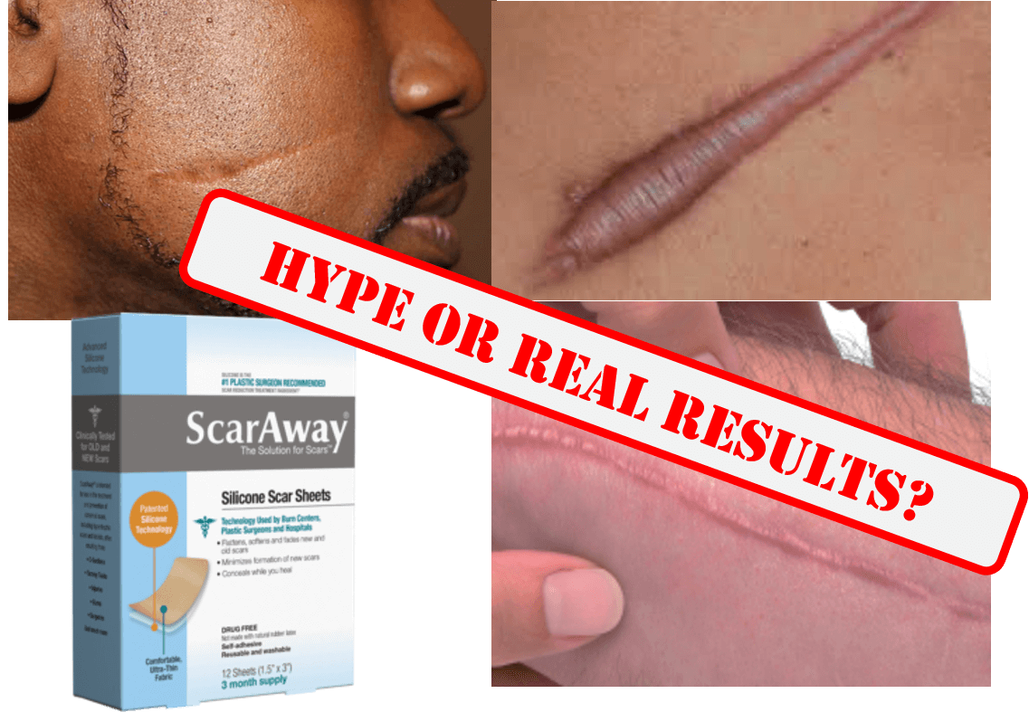 best silicone scar sheets for keloid