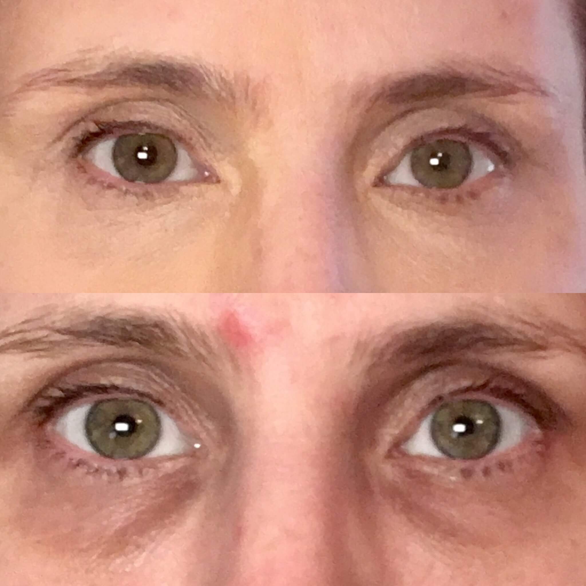 Vitamin D Deficiency And Dark Circles Under Eyes ...