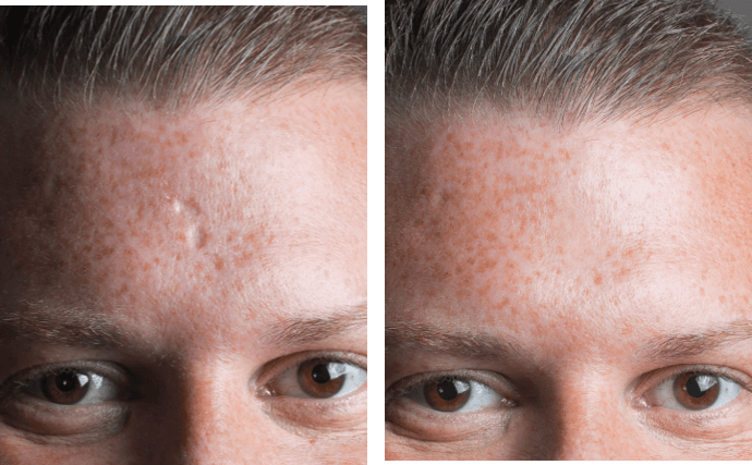 acne pock mark removal