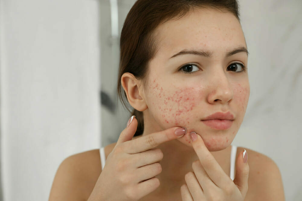 Types Of Acne Scars Do Acne Scars Go Away